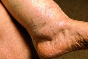 Foot оток в напреднала възраст причините и лечението
