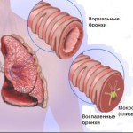 Лош тръгва от храчки кашлица при възрастни причини