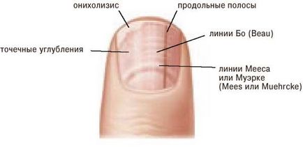 Защо ноктите далеч от кожата причините и лечение на ноктите