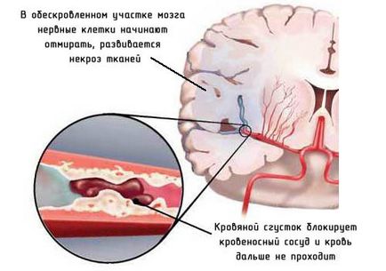 Последиците от мозъчен инфаркт (сърдечен удар) Последиците от мозъчен инфаркт