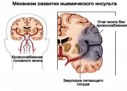 Последиците от мозъчен инфаркт (последиците на мозъчен инфаркт) Последиците от мозъчен инфаркт