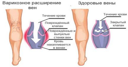 А кръвен съсирек в крака предизвиква симптомите, лечението и последствия