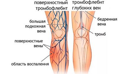 А кръвен съсирек в крака предизвиква симптомите, лечението и последствия