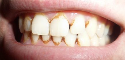 отстраняване на зъбен камък у дома, за да се отървете от този проблем бързо и без вреда, включително