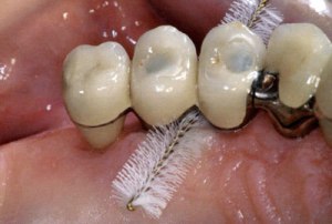 скоби на зъбите подравняване преди и след резултати със снимки, мнения за лекари и пациенти