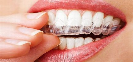 скоби на зъбите подравняване преди и след резултати със снимки, мнения за лекари и пациенти