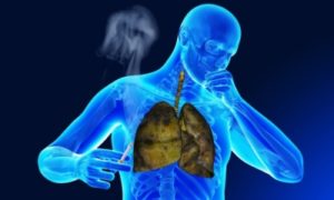 лечение бронхит Хронична пушачи и симптоми, ефективно лечение, отколкото лечение