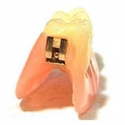 Зъбни протези пеперуда (незабавни протези)
