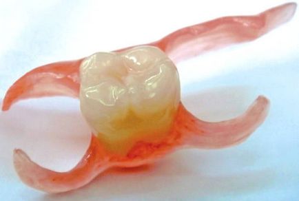 Зъбни протези пеперуда (незабавни протези)