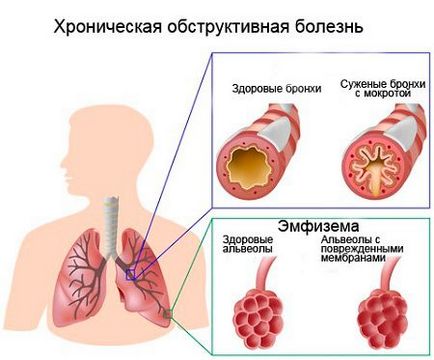 Какво е запушване на бронхите