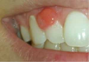 Flux Лечение на венците