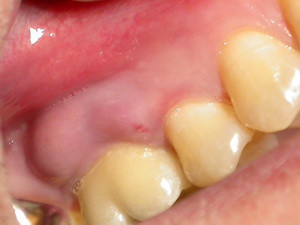 Flux Лечение на венците