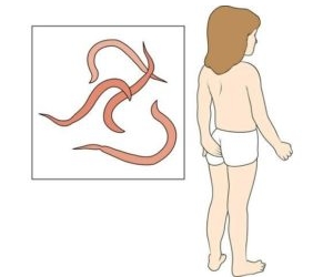 Симптомите, които имат червеи