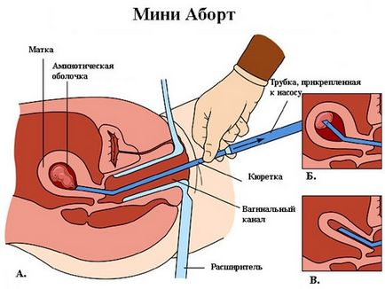 Как да направите аборт в домашни условия