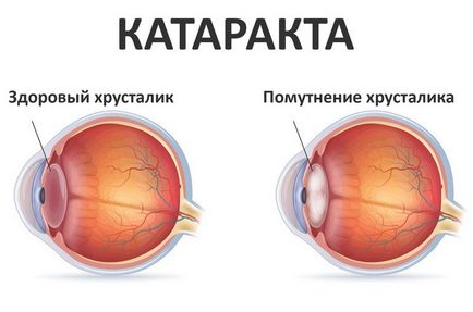 Що за катаракта болестни