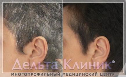 Лечението на сива коса