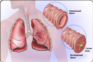 Какво е запушване на бронхите