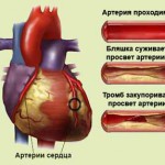 Какво прави кръвен съсирек се откъсне