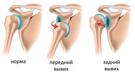 Как да се намали на рамото