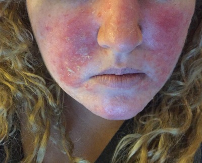 Аз съм алергичен към лицето