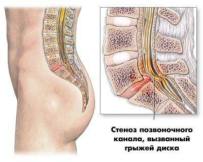 Какво е спинална стеноза