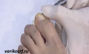 Врастнали нокти на краката, отколкото лечение