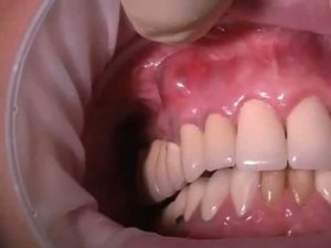 Какво е абсцес на венците