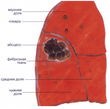 Абсцес на белия дроб, което е