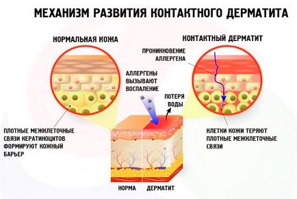 Дерматит какво да правя