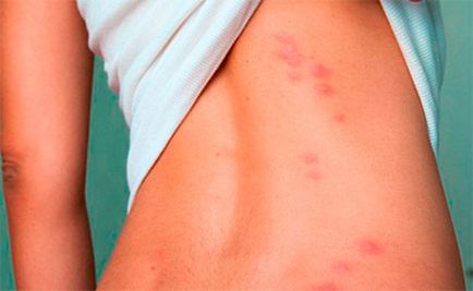 Алергични към ухапване от комари