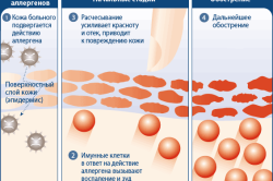 Да се ​​вземат с алергия към армията