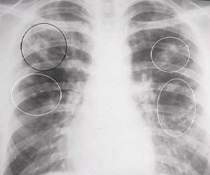 Какво е белодробна tuberculoma