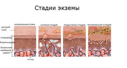 Лицето лечение екзема