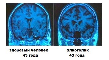 лечение на мозъка енцефалопатия