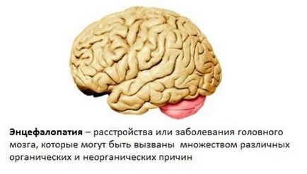 лечение на мозъка енцефалопатия