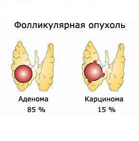 монтаж отстраняване на щитовидната жлеза