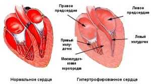 Лечение на хипертрофия на лявата камера на сърцето