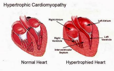 Лечение на хипертрофия на лявата камера на сърцето