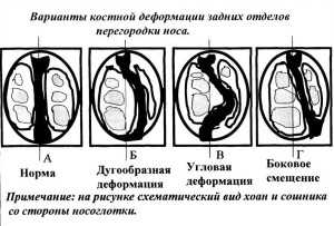 Корекция на носната преграда като