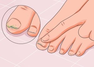 Какво може да лекува гъбички на ноктите
