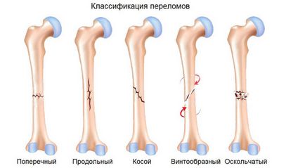 Какво е фрактура ключицата