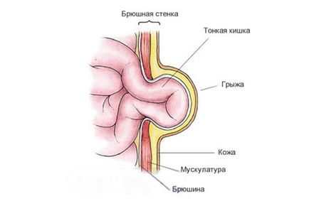 Пъпна херния лечение при деца