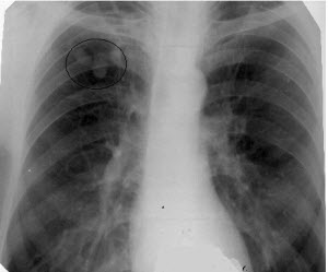 Какво е белодробна tuberculoma Какво е белодробна tuberculoma