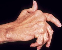 Лечение на стави на ръцете народни средства