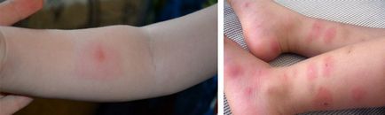 Алергии към ухапвания от бълхи, кърлежи, комари и дървеници, лечение на възрастни и деца, фото ухапвания от насекоми