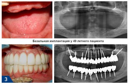 Базовите импланти - Мнения на плюсовете и минусите, цената за 2017 (имплантиране) Базовите импланти - Мнения на плюсовете и минусите, цената за 2017