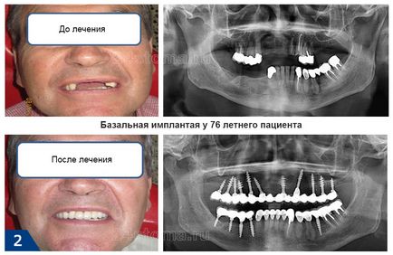 Базовите импланти - Мнения на плюсовете и минусите, цената за 2017 (атрофия на костната тъкан) Базовите импланти - Мнения на плюсовете и минусите, цената за 2017