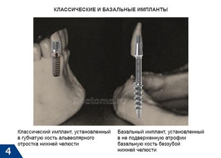 Базовите импланти - Мнения на плюсовете и минусите, цената за 2017 (базална) Базовите импланти - Мнения на плюсовете и минусите, цената за 2017