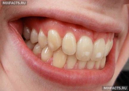 А бяло петно ​​върху зъба причини и лечение