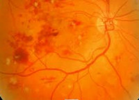 Диабетна ретинопатия - причини, симптоми, диагностика и лечение